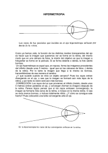 HIPERMETROPIA