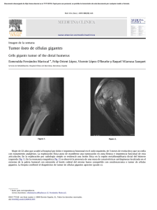 Tumor o´seo de ce´lulas gigantes ARTICLE IN PRESS
