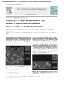 Dehiscencia de la tercera porción del nervio facial