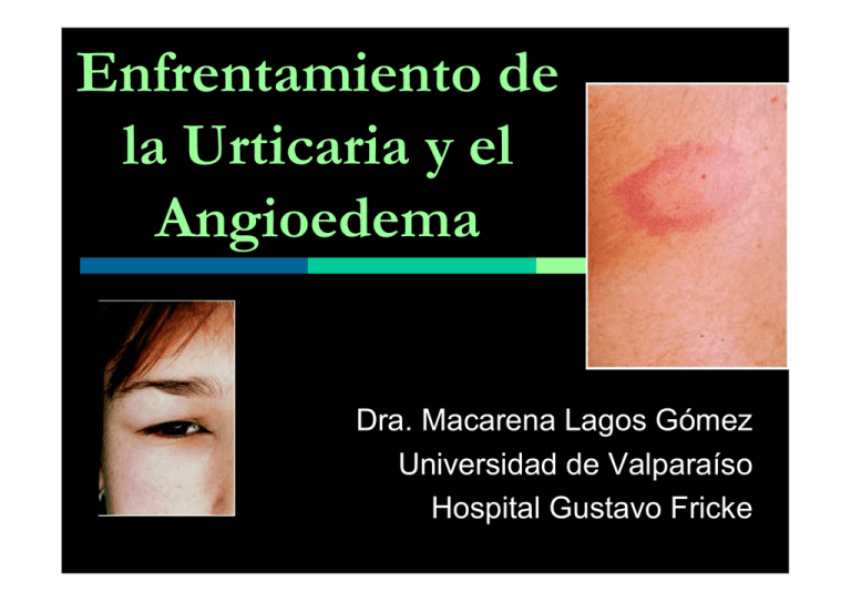 Enfrentamiento De La Urticaria Y El Angioedema