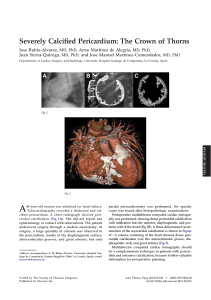 Calcified Pericardium: The Crown of Thorns - Case Study